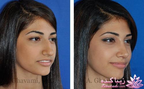 جراحی بینی - جراحی زیبایی