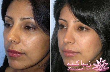 جراحی بینی - جراحی زیبایی