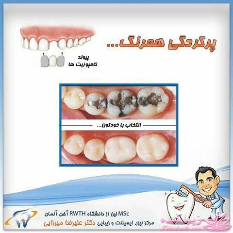 مواد همرنگ دندان چیست؟