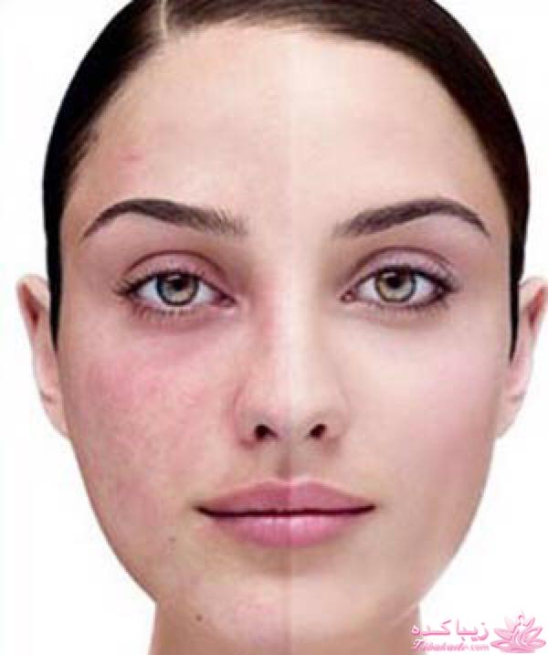 از بین بردن لک های پوست
