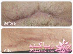 میکرونیدلینگ موثرترین روش جوانسازی و ترمیم پوست