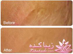 میکرونیدلینگ موثرترین روش جوانسازی و ترمیم پوست