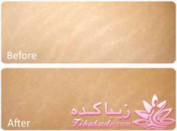 میکرونیدلینگ موثرترین روش جوانسازی و ترمیم پوست