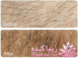 میکرونیدلینگ موثرترین روش جوانسازی و ترمیم پوست