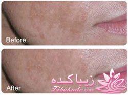 میکرونیدلینگ موثرترین روش جوانسازی و ترمیم پوست