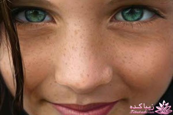 درمان های طبیعی کک و مک و لکه های پوستی