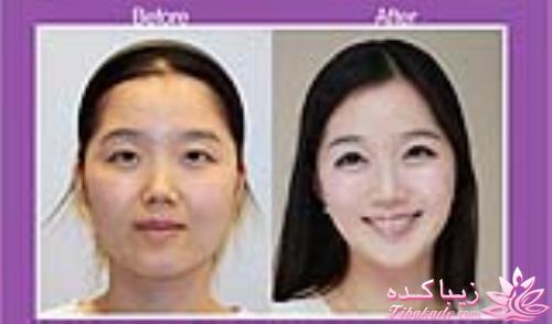 نبوغ کره ای ها در جراحی زیبایی!!!!!!!!!!!!!!!!