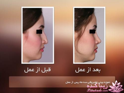 جراحی بینی - جراحی زیبایی