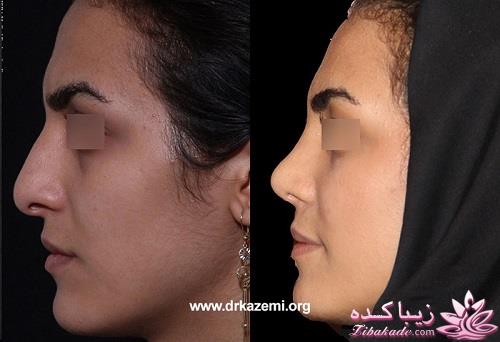 جراحی بینی - جراحی زیبایی