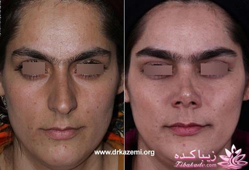 جراحی بینی - جراحی زیبایی