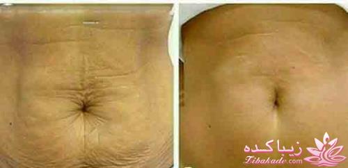پوست کش آمده پس از لاغر شدن را با این روش برای همیشه صاف کنید.