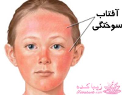 آفتاب سوختگی و راههای پیشگیری و درمان آفتاب سوختگی
