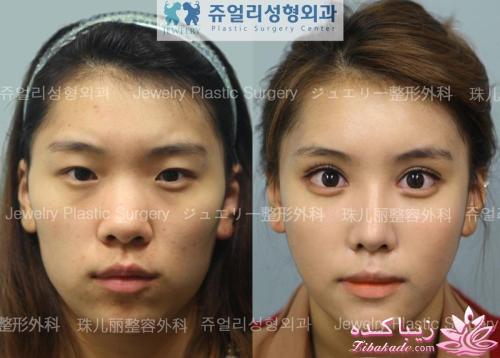 نبوغ کره ای ها در جراحی زیبایی!!!!!!!!!!!!!!!!