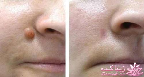 روشی برای رهای از زگیل