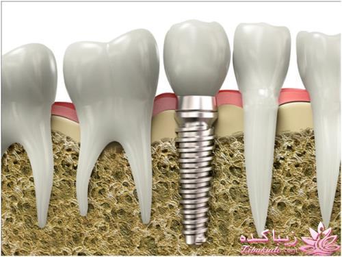 فواید ایمپلنت دندانی