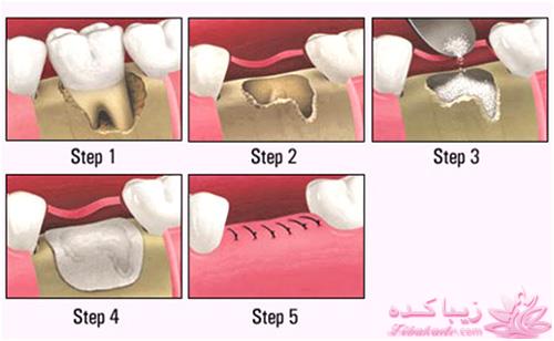  بازسازی استخوان فک برای درمان ایمپلنت 