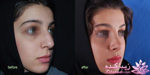 جراحی بینی - جراحی زیبایی