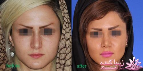 جراحی بینی - جراحی زیبایی
