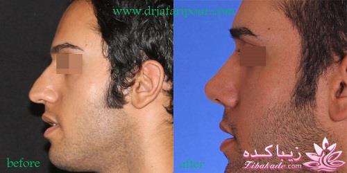 جراحی بینی - جراحی زیبایی