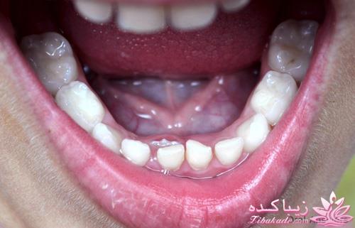 رویش دندانهای دائمی در جلوی دندانهای شیری (دندان کوسه ای)