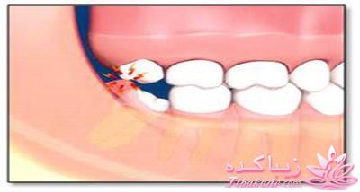 فوریتهای دندانپزشکی در کودکان چیست؟