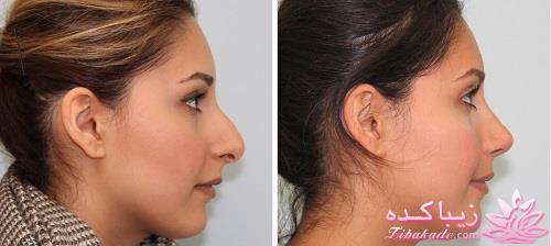 جراحی بینی - جراحی زیبایی