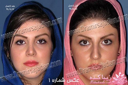 جراحی بینی - جراحی زیبایی