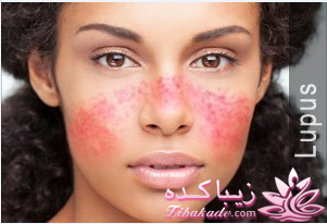 با بیماری لوپوس آشنا بشوید