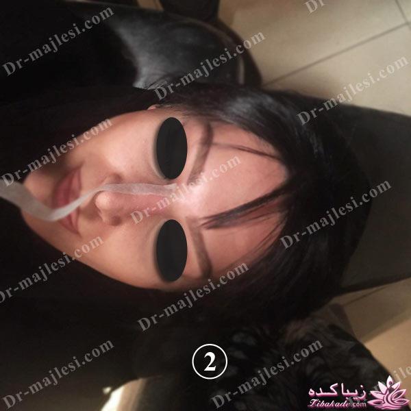 جراحی بینی - دکتر محمد مجلسی