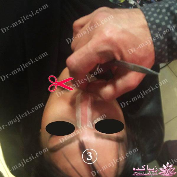 جراحی بینی - دکتر محمد مجلسی