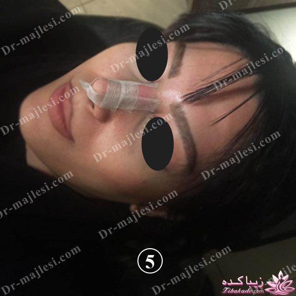 جراحی بینی - دکتر محمد مجلسی