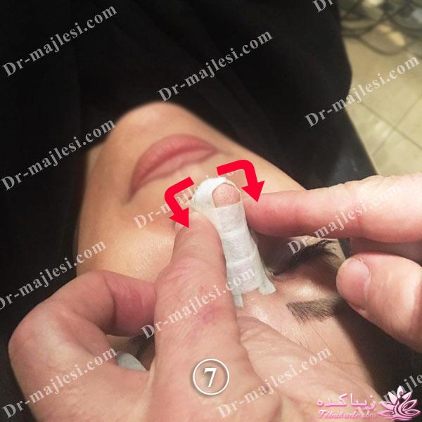 جراحی بینی - دکتر محمد مجلسی