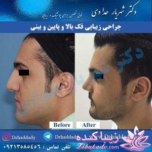 جراحی بینی - جراحی زیبایی