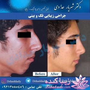 جراحی بینی - جراحی زیبایی