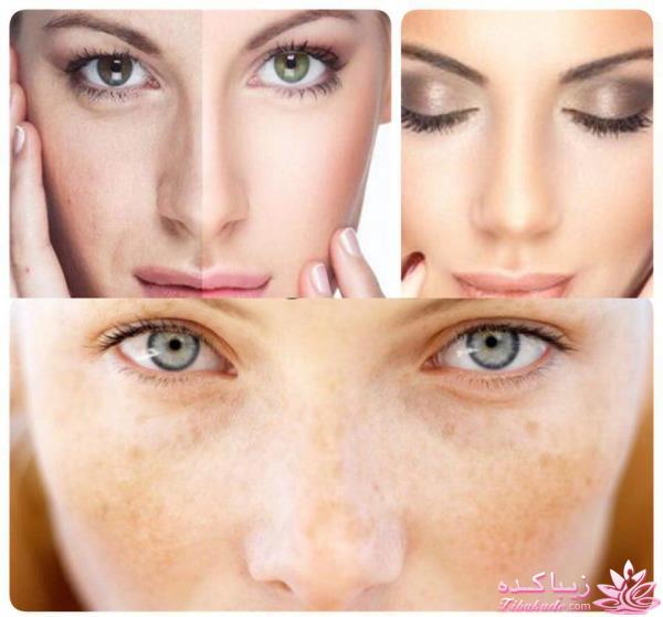 درمان لکه های قهوه ای پوست