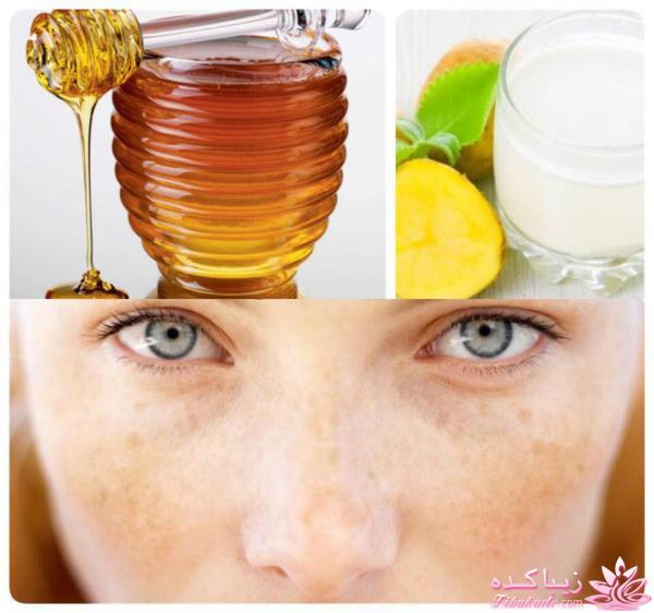 درمان لکه های قهوه ای پوست