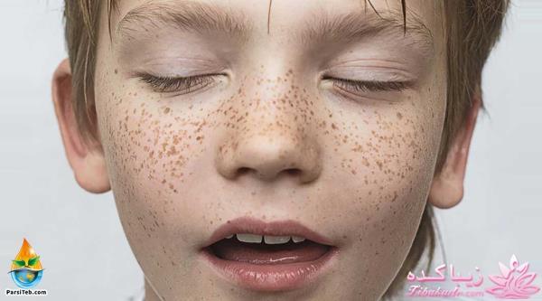 چگونه از دست کک و مک نجات پیدا کنیم؟