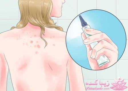جوش پشت بدن و شانه را چگونه از بین ببریم؟