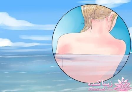 جوش پشت بدن و شانه را چگونه از بین ببریم؟