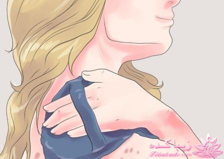 جوش پشت بدن و شانه را چگونه از بین ببریم؟