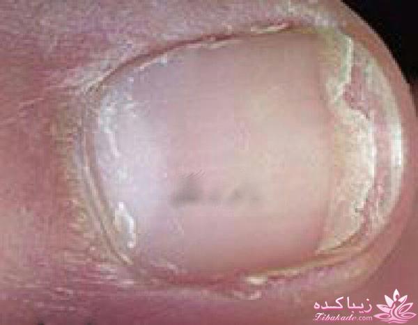 تشخیص بیماری با ناخن 