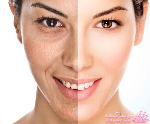 چگونه از شره سلولیت ها راحت شویم؟