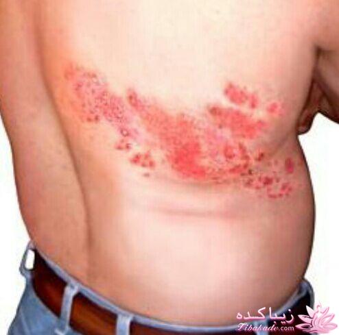 #زونا  زونا  Herpes zoster یک بیماری ویروسی است که عامل مولد آن ویروس واریسلا زوستر است که ه