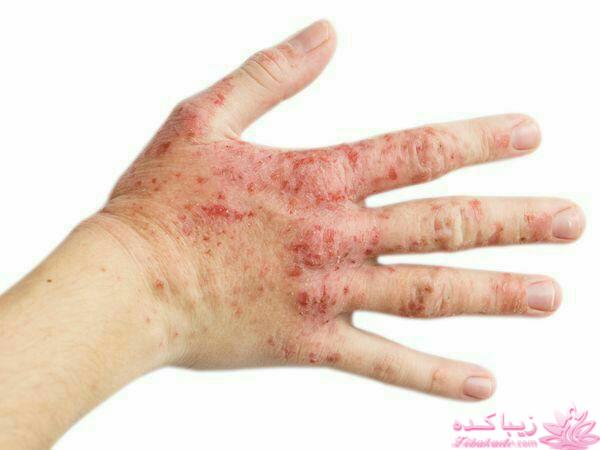 درمان بدون دارو