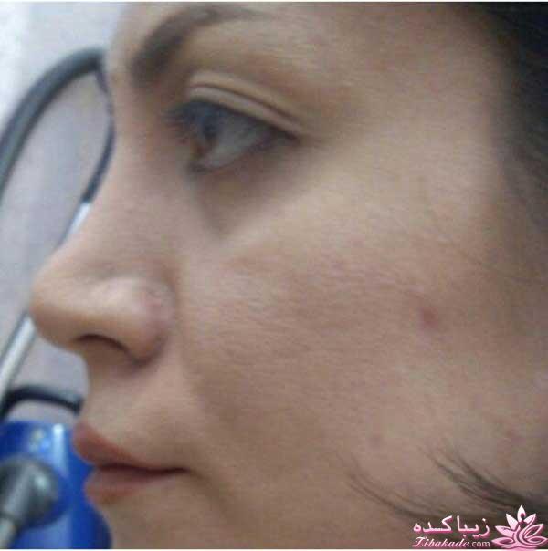 جراحی بینی - دکتر محمد مجلسی