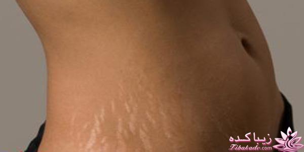 استریا(ترک چاقی لاغری و زایمان و درمان آن)