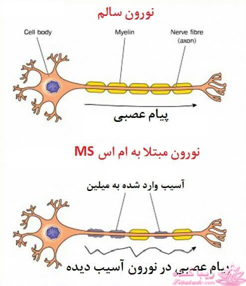 بیماری ام اس