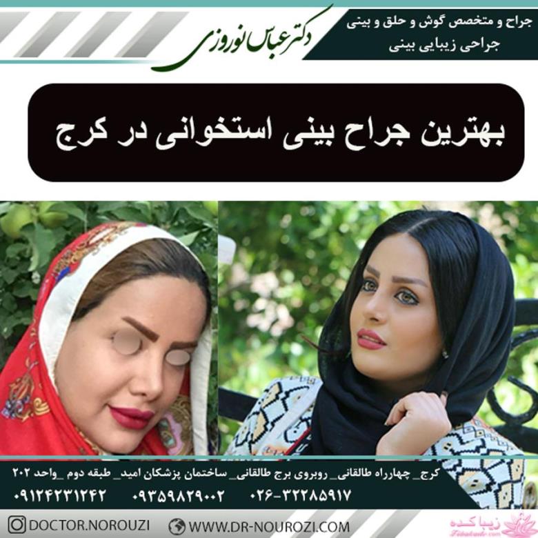 بهترین جراح بینی استخوانی در کرج