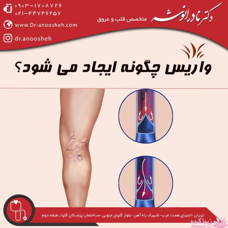 واریس و علایم آن