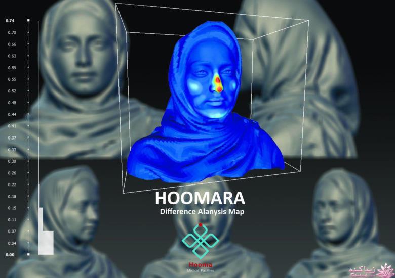 جراحی بینی - جراحی زیبایی